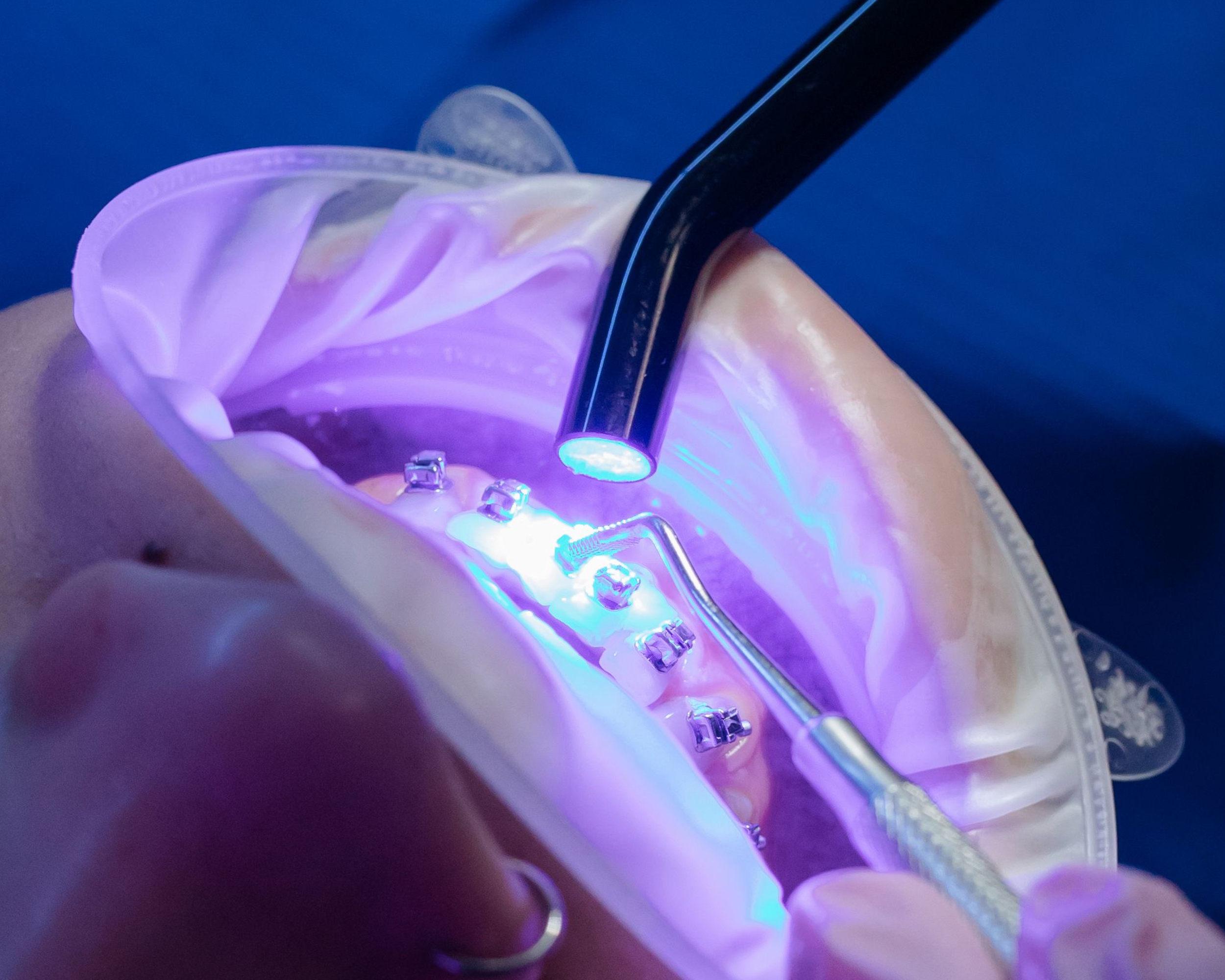 Blanqueamiento Dental