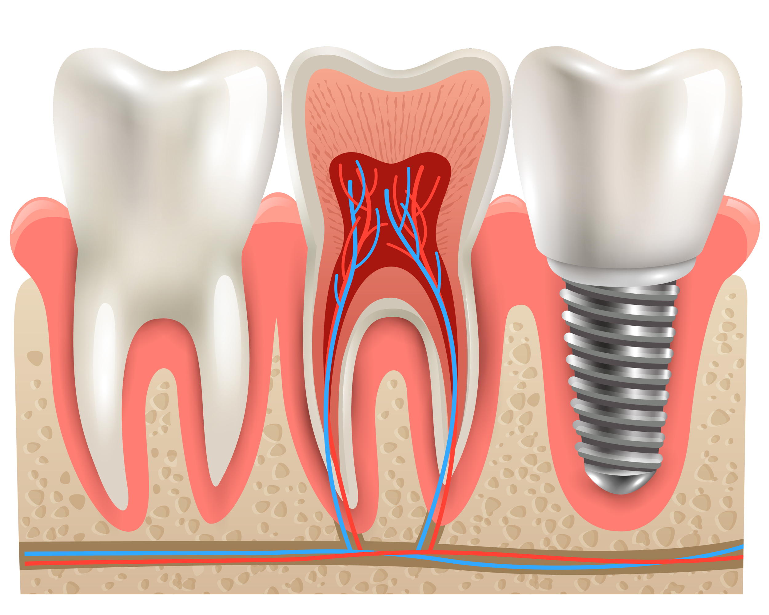 Implantes